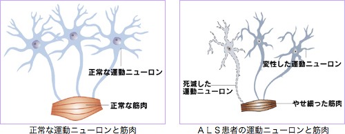 正常な運動ニューロンと筋肉・ALS患者の運動ニューロンと筋肉